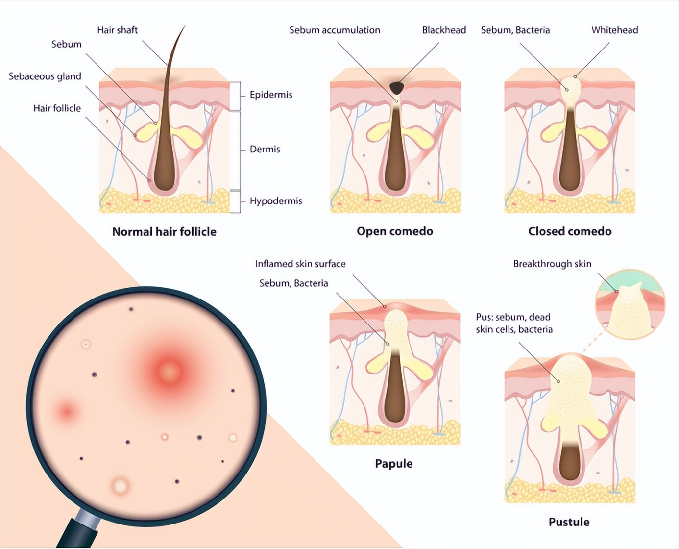 不同原因形成的青春痘，其治疗方式都一样吗？医生：女生不一样
