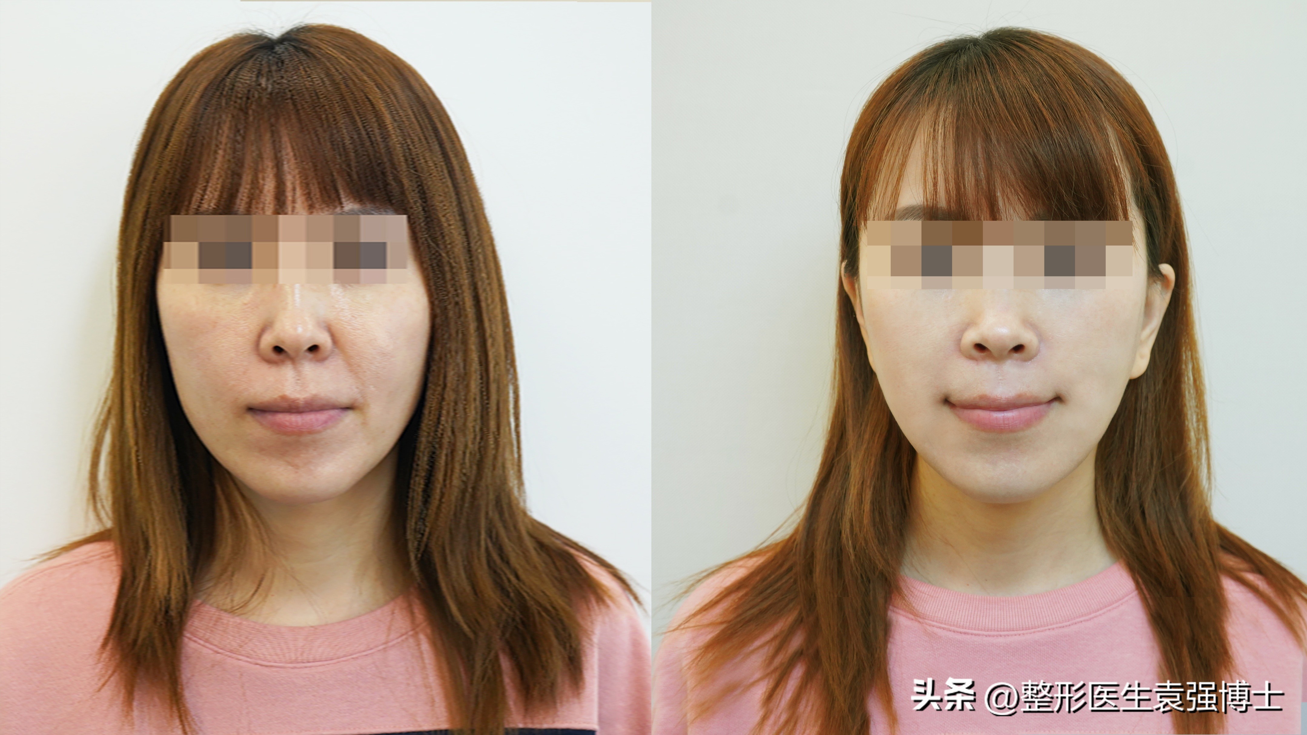 治法令纹有什么妙招,有法令纹做什么效果比较好