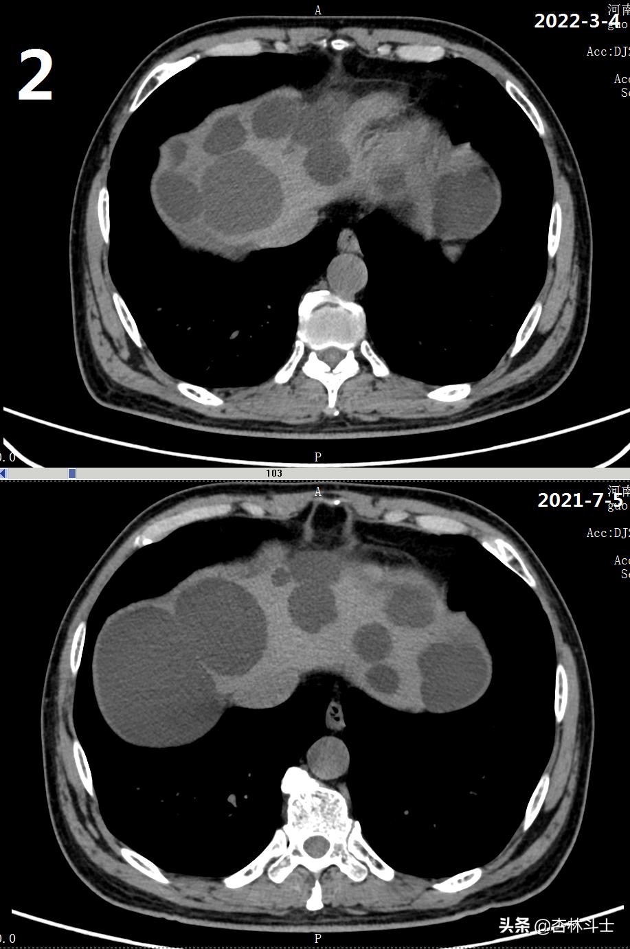 64岁银行职员患肝囊肿,CT引导下细针穿刺抽吸酒精硬化解决大问题
