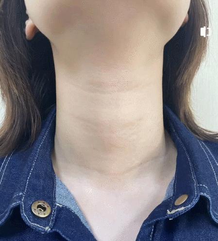 如何去颈纹不用颈纹霜,凡士林颈纹霜去除颈纹有效果吗