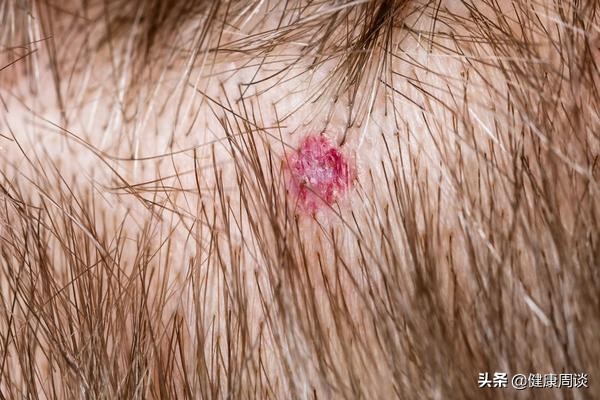 头皮发痒长疙瘩什么原因造成的,头皮发痒长疙瘩是什么原因引起的