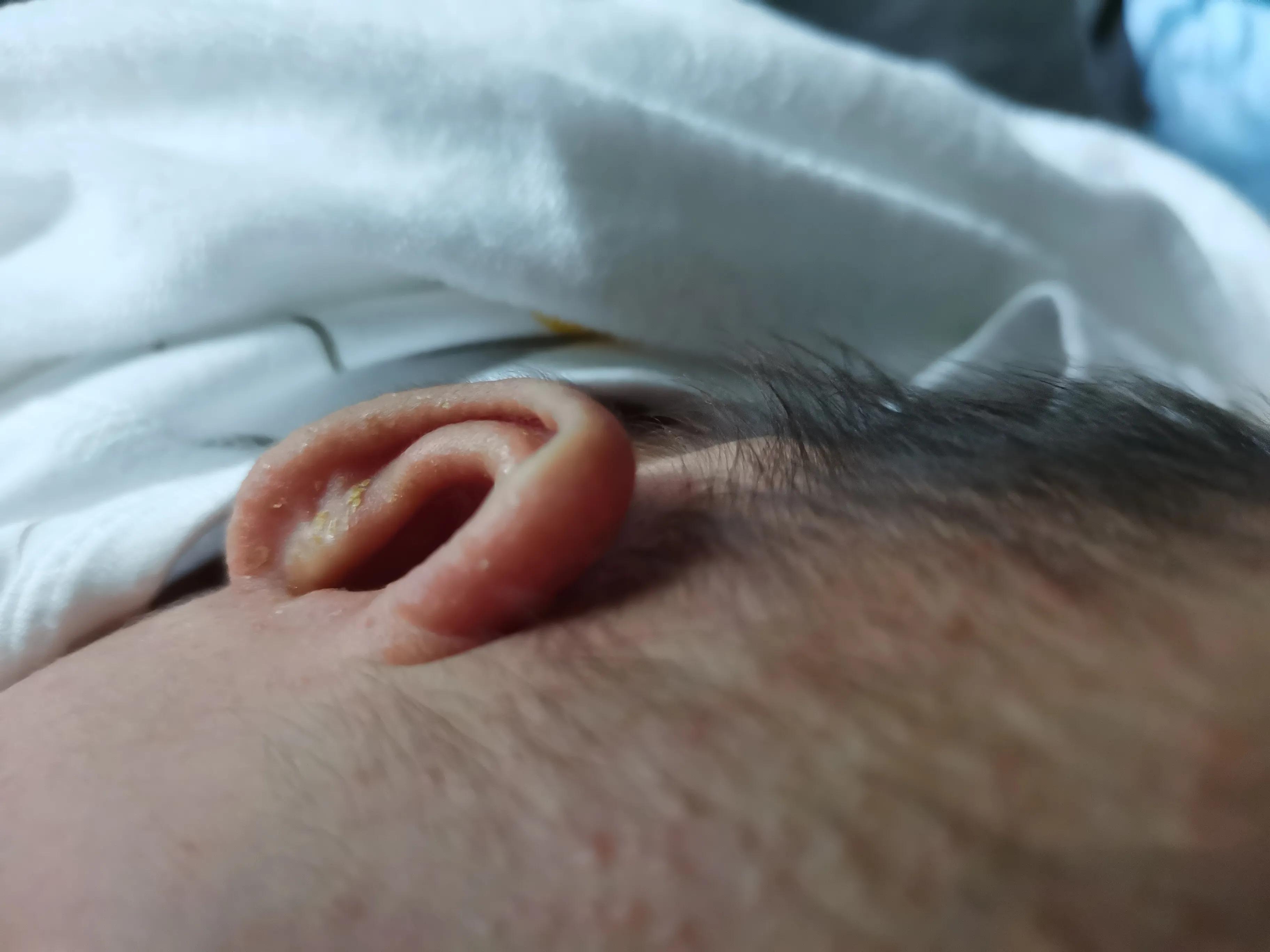 南方孩子长湿疹,南方的婴儿容易出湿疹吗