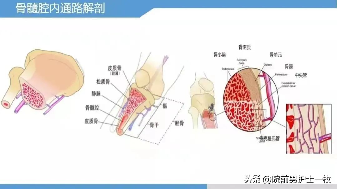 骨髓腔穿刺急救,骨髓腔穿刺适应症和禁忌症