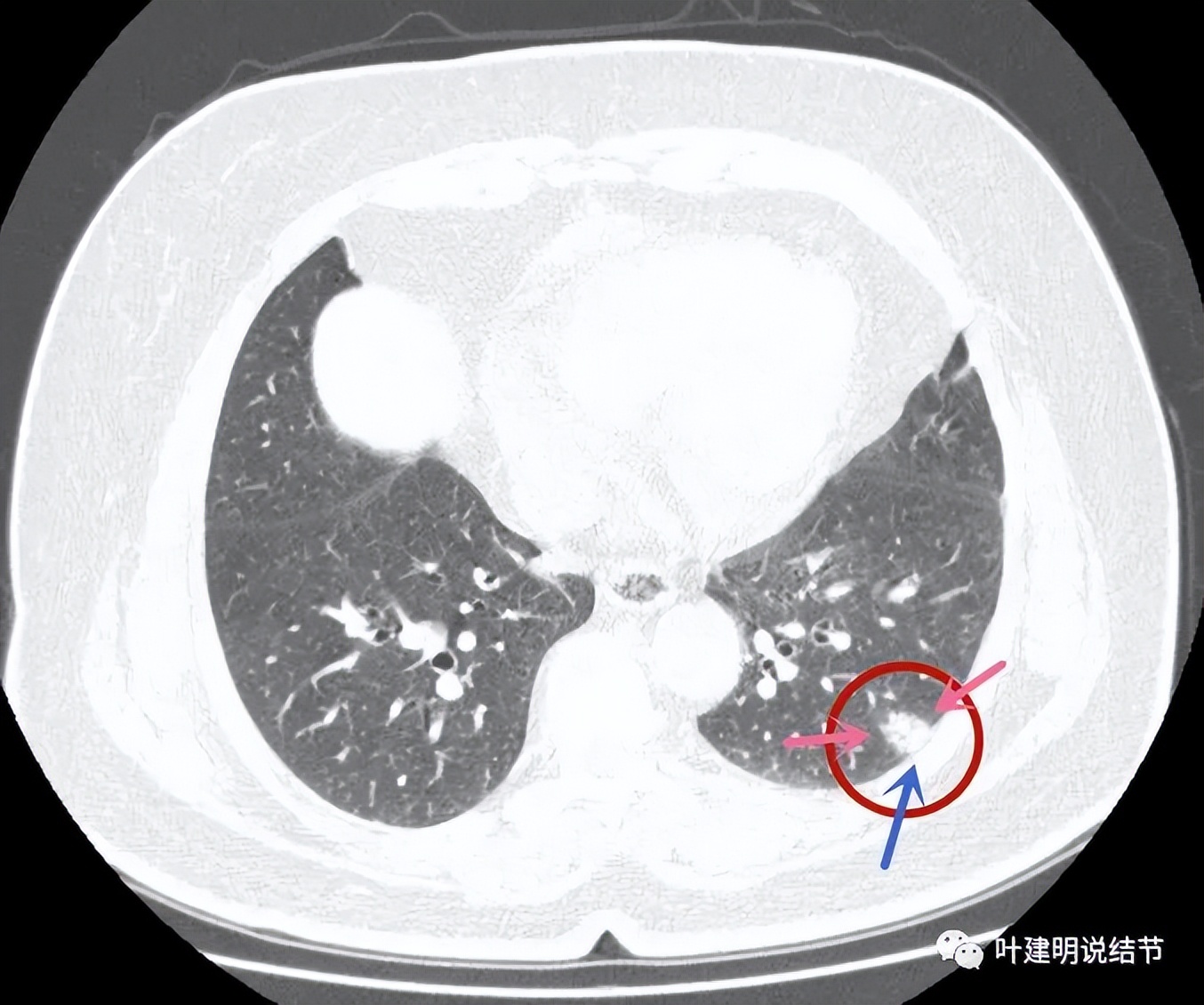 肺结节实性为什么建议抗炎治疗,肺上实性结节抗炎后变成空洞