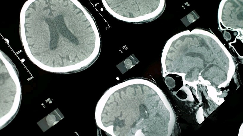 冠脉造影对身体有多大影响,做了冠脉造影对周围有辐射吗