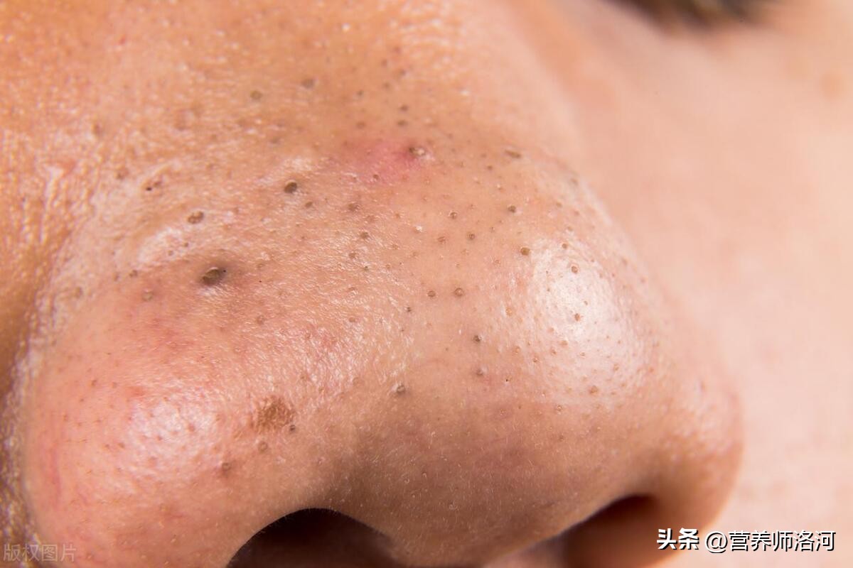 鼻头有黑头如何祛除小窍门,鼻头黑头可以喝什么来改善