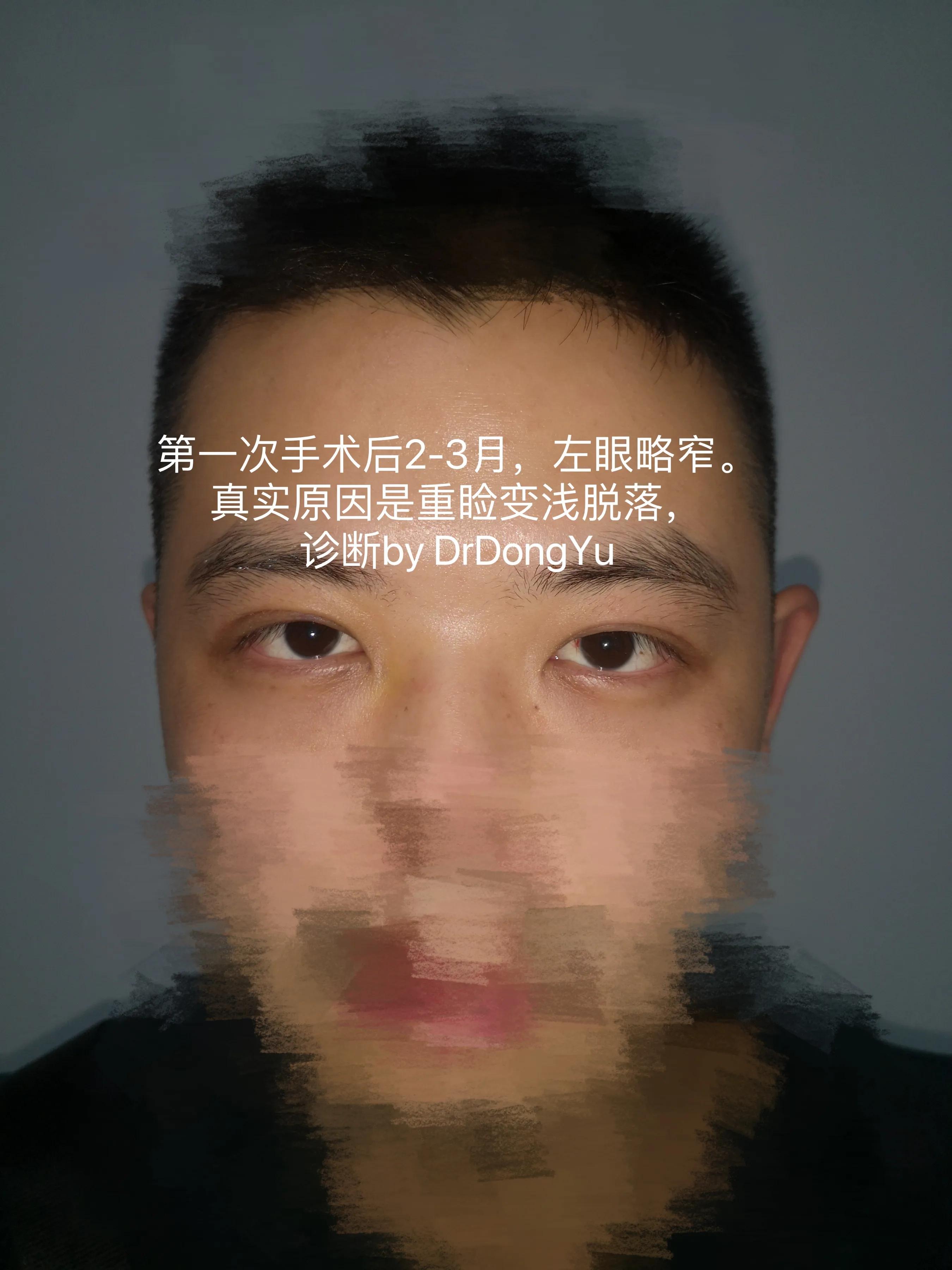 提肌手术多长时间能恢复,严重受损发质修复