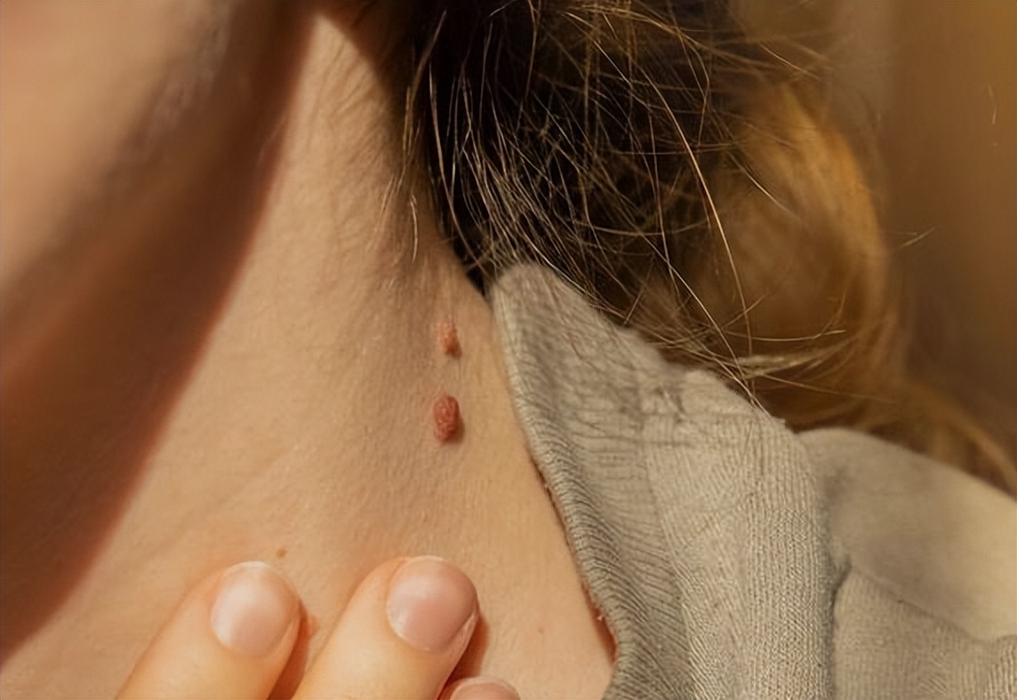 脖子上小肉粒可以揪下来,脖子上长的小肉粒自己揪掉可以吗