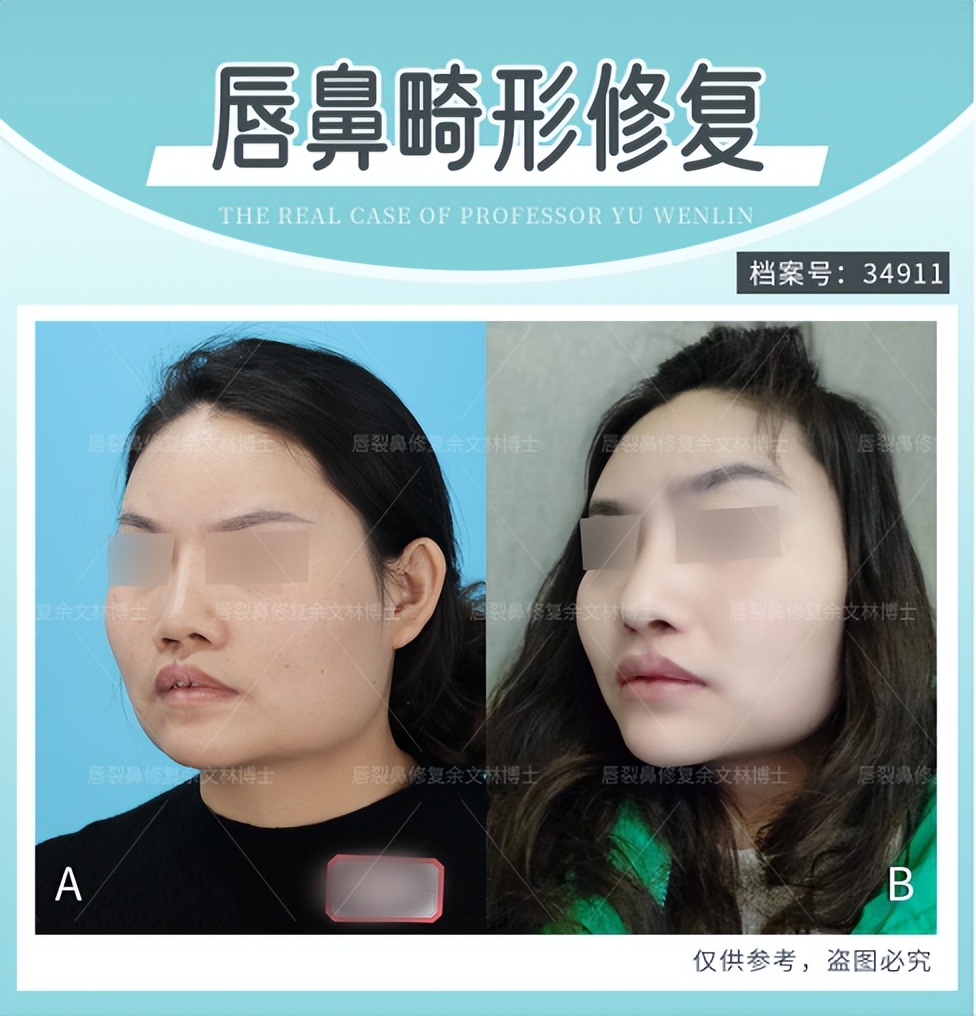 唇裂的分级,唇裂看病经验分享