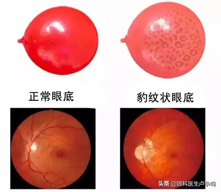眼底检查怀疑有裂纹,眼底出现裂痕原因