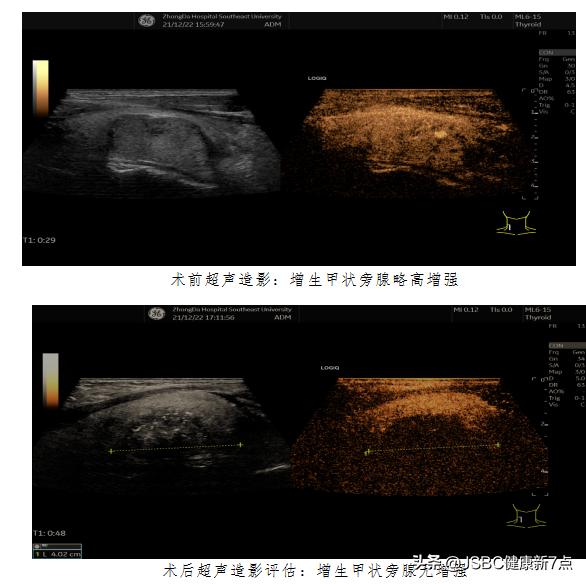 甲状旁腺增生做增强ct,甲状旁腺增生手术