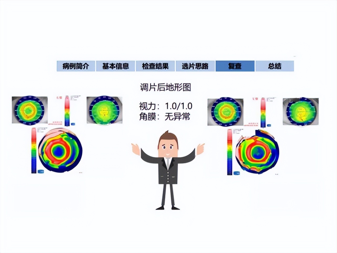 王凯角膜塑形镜原理,王凯医生塑形镜