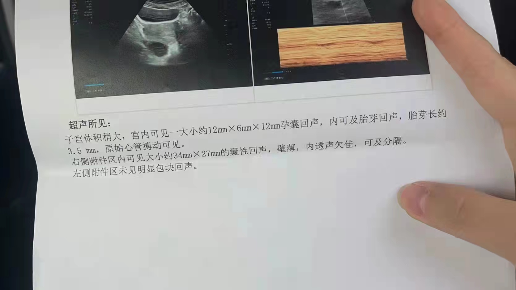 不全纵隔子宫y型能正常怀孕吗,子宫不全纵隔0.6厘米需要动手术么