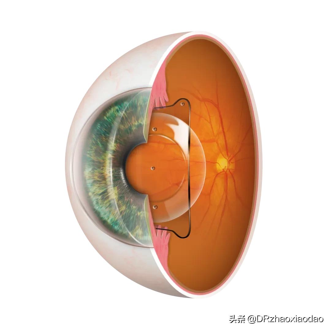 icl植入术技术问题,icd植入适应症指南