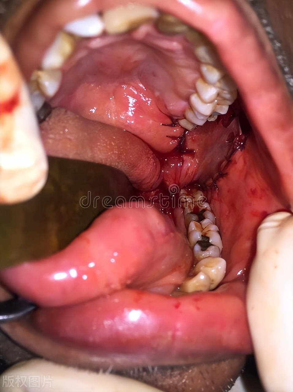 口腔癌症的初期症状和危害,口腔癌症的初期表现症状是什么