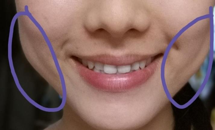 笑的时候脸颊有两坨肉怎么改善,笑起来脸上鼓出两坨肉僵硬