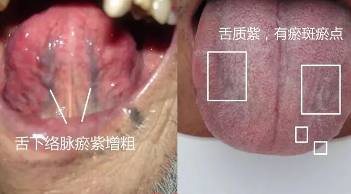 子宫肌瘤是怎么回事，怎么治才合理？老中医教你，一个泡脚方