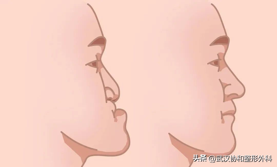 唇腭裂做一次手术就好了吗,唇腭裂一次性做完鼻子好吗