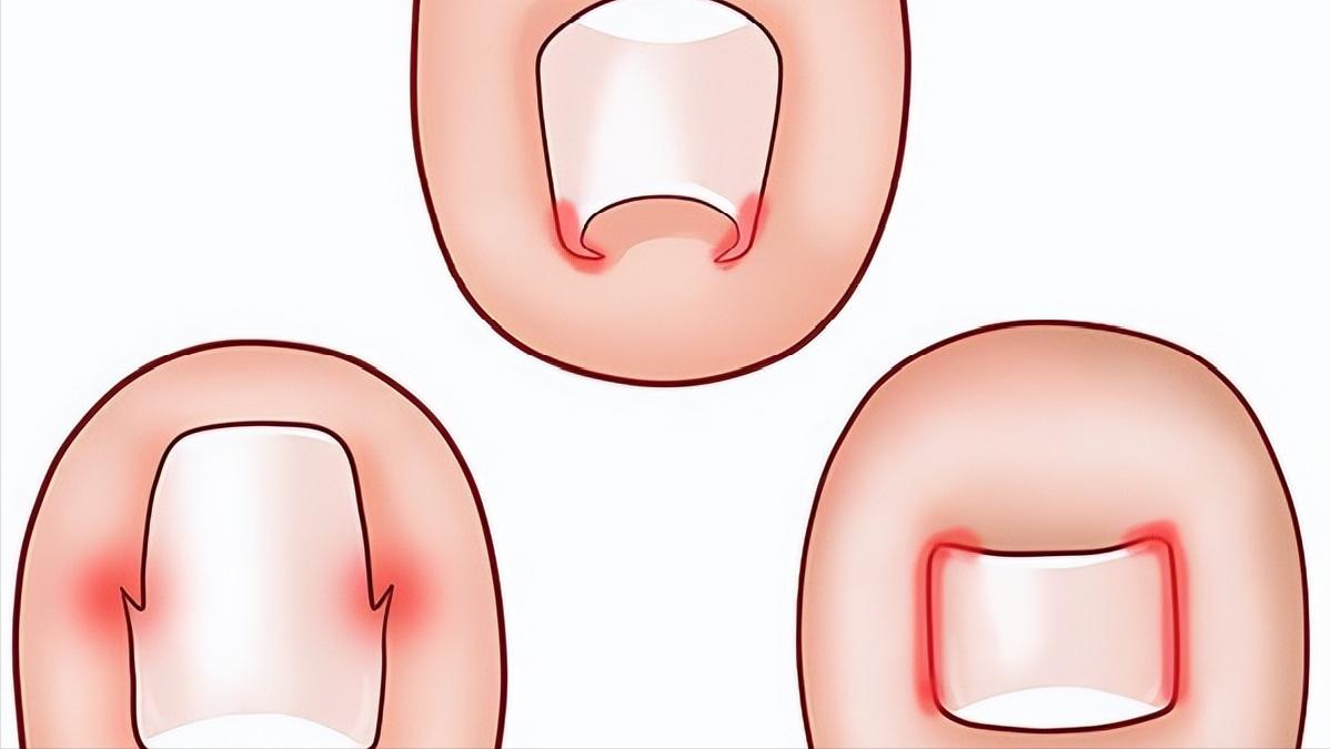 甲沟炎如何快速拔出脚趾甲,脚趾甲老往肉里钻一碰还疼