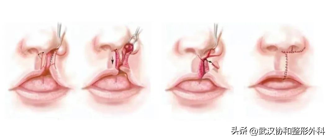 唇腭裂做一次手术就好了吗,唇腭裂一次性做完鼻子好吗