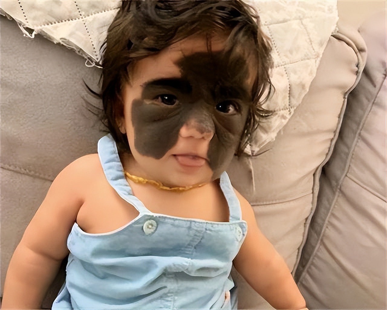 小女孩胎记后续,女童脸上长胎记去哪个医院