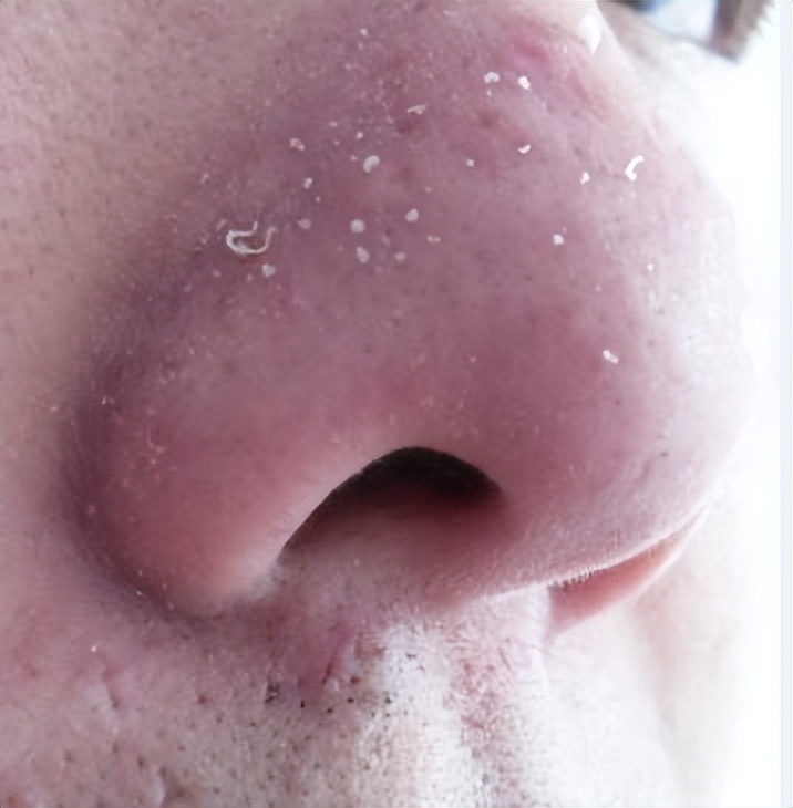 额头眉心发红有闭口粉刺,眉心鼻头频繁起粉刺怎么办