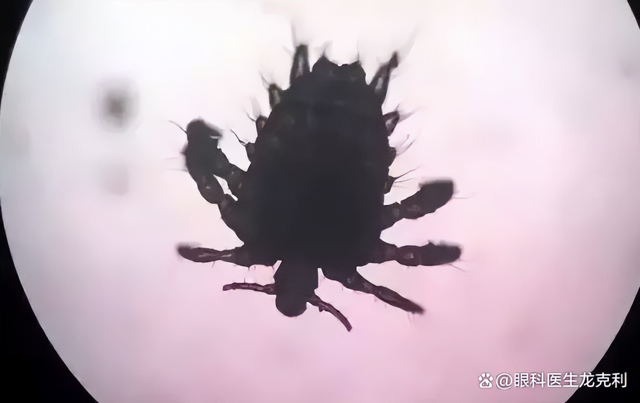 眼睛会看到虫子是什么原因,眼睛里面有虫子的特征