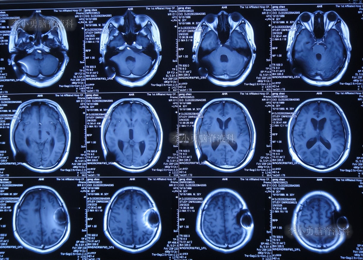 脑积水三脑室造瘘多久能恢复,脑囊虫手术后脑积水