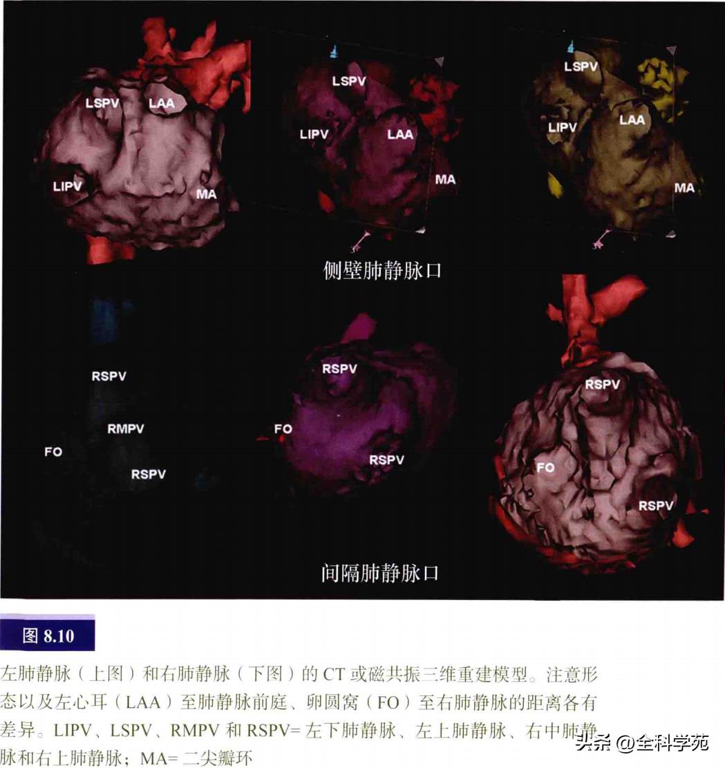 连接左心房的是肺静脉吗,左心房与肺静脉解剖