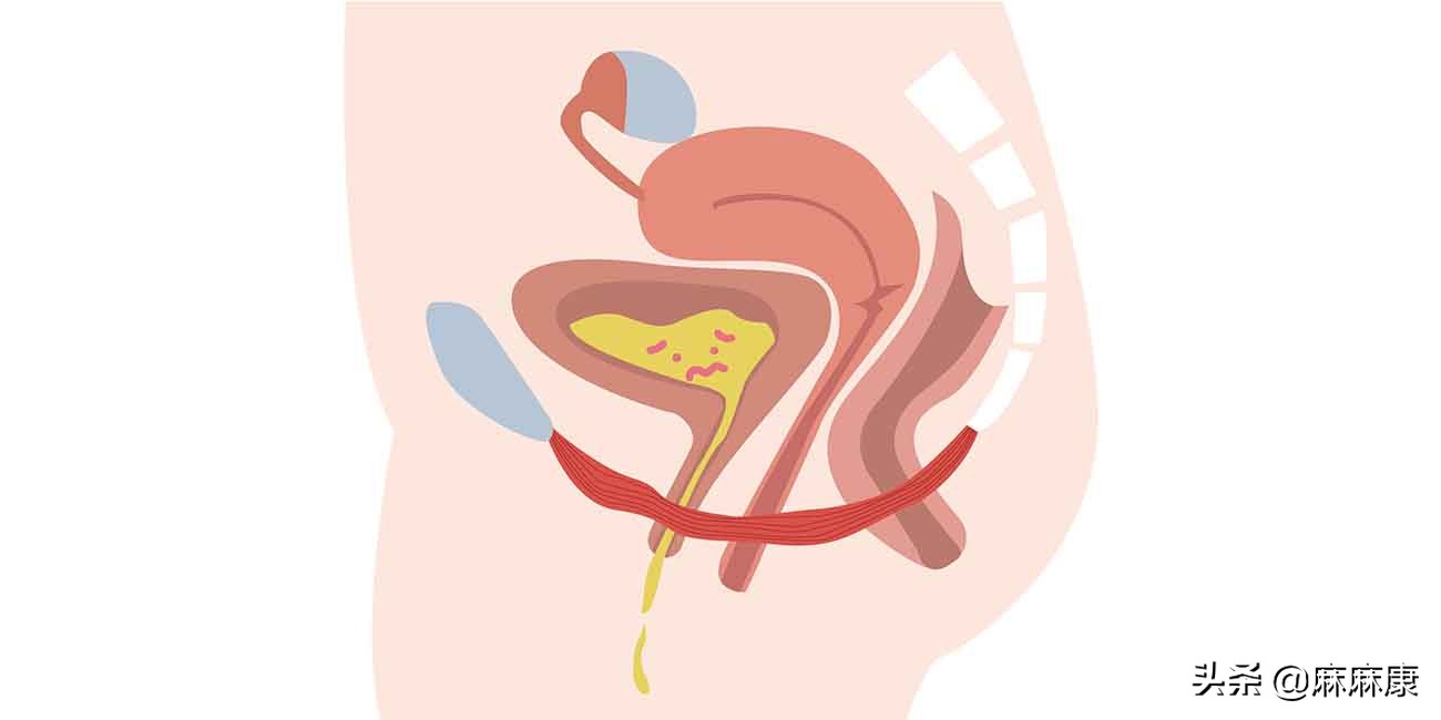 盆底肌修复神器有效吗,盆底肌修复要做多久才有效