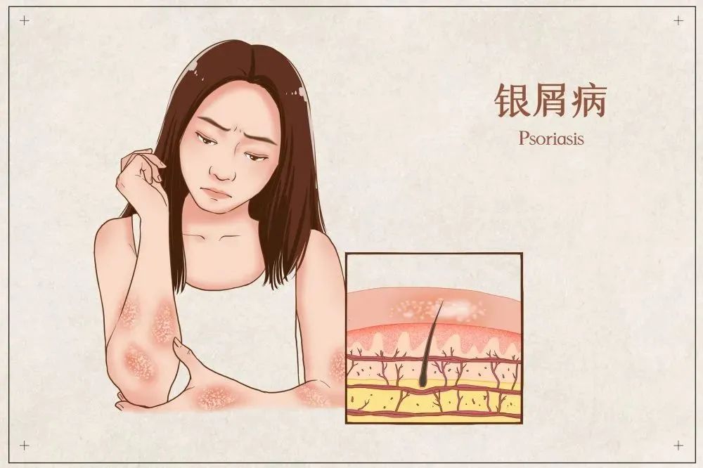 济南银屑病哪个医院治得好,济南银屑病医院能治好银屑病吗