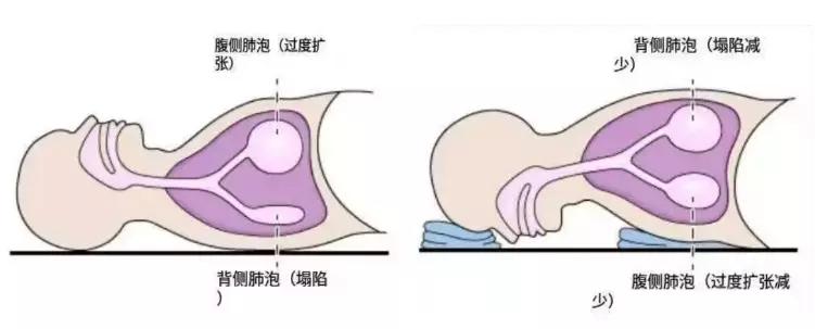 新冠趴着有利于呼吸吗,新冠感染肺后胸闷该怎么办