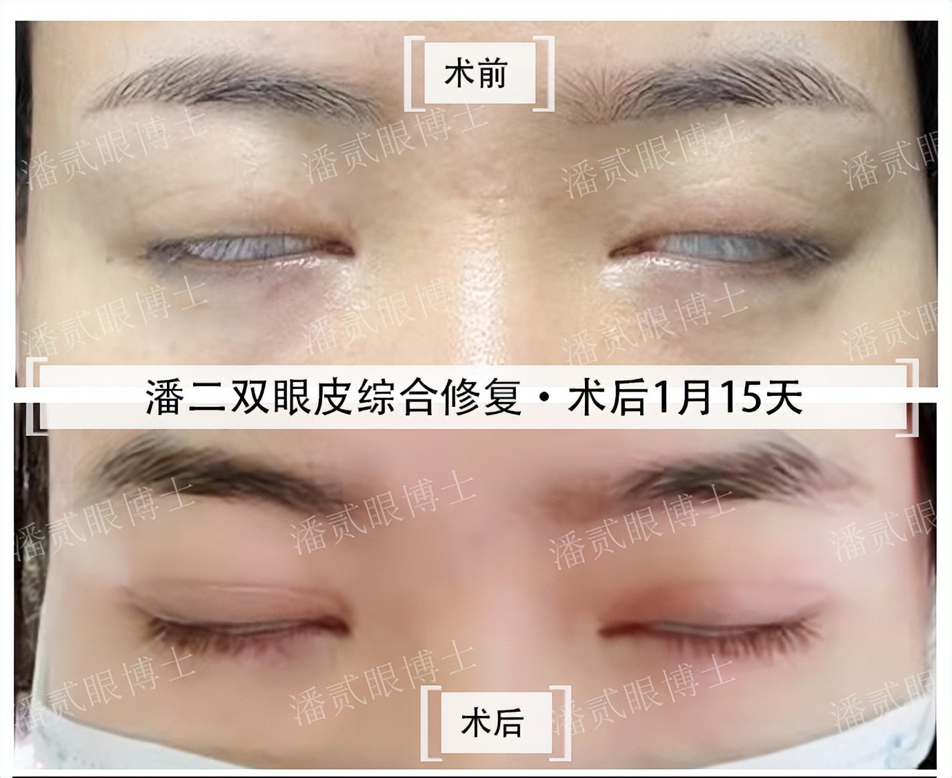 整容后眼睛不能闭合,整容失败眼睛无法闭合