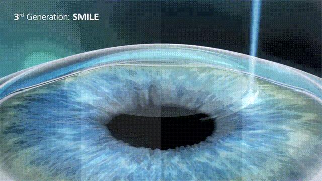 徐州飞秒激光近视手术大概多少钱,激光矫正近视手术全过程全飞秒