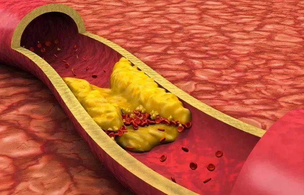 进口他汀和国产他汀价格,进口他汀比国产的副作用小吗