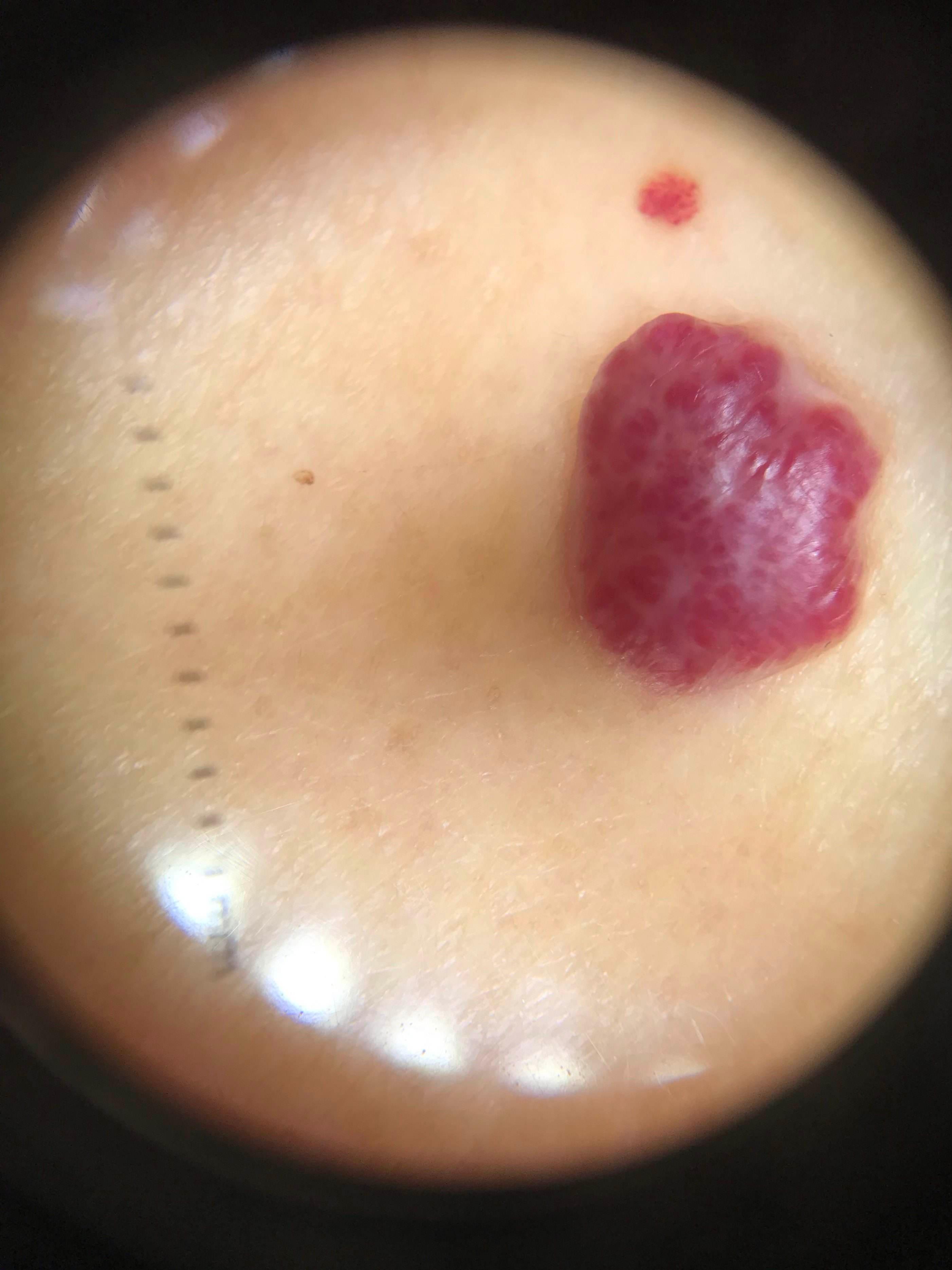 激光点痣适合多大的痣,脸上有痣能激光点痣吗