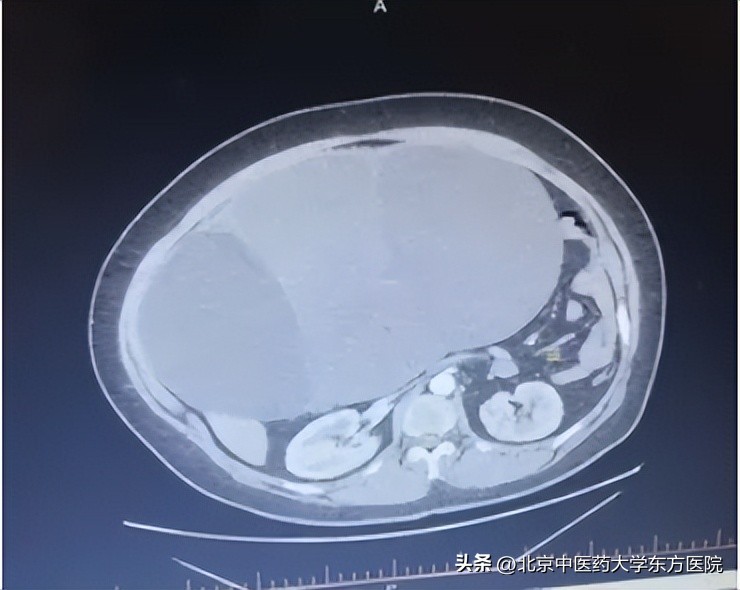腹腔镜切除卵巢肿瘤,女子肚大似怀孕医生成功摘肿瘤