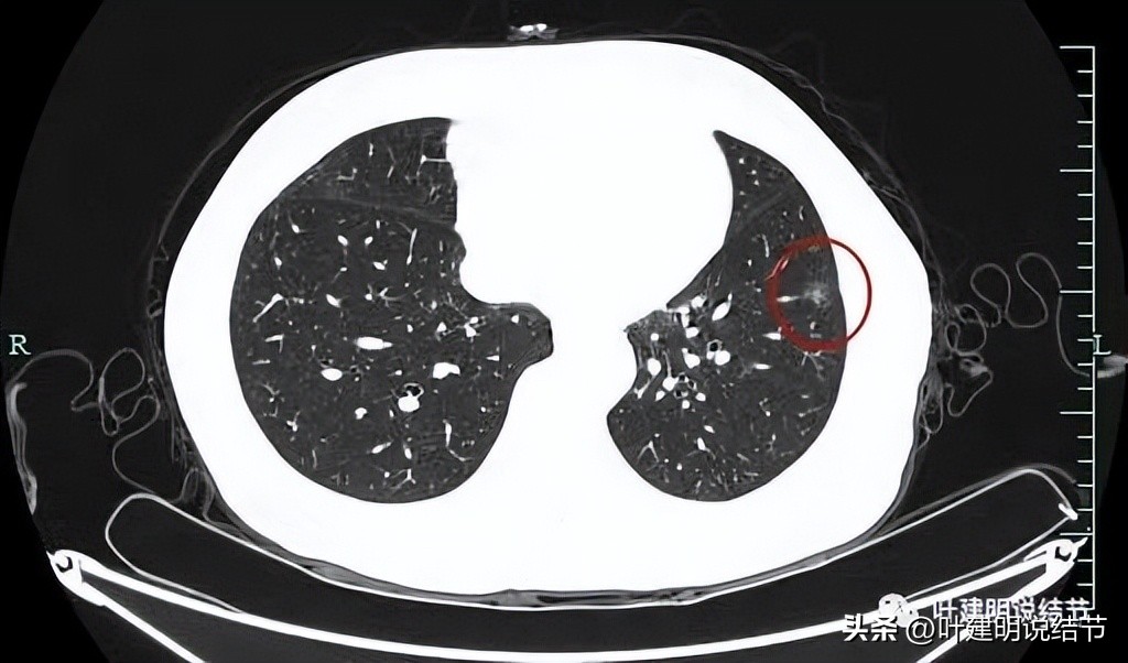 辽宁省肺结节手术哪家医院好,辽宁肺结节手术医院