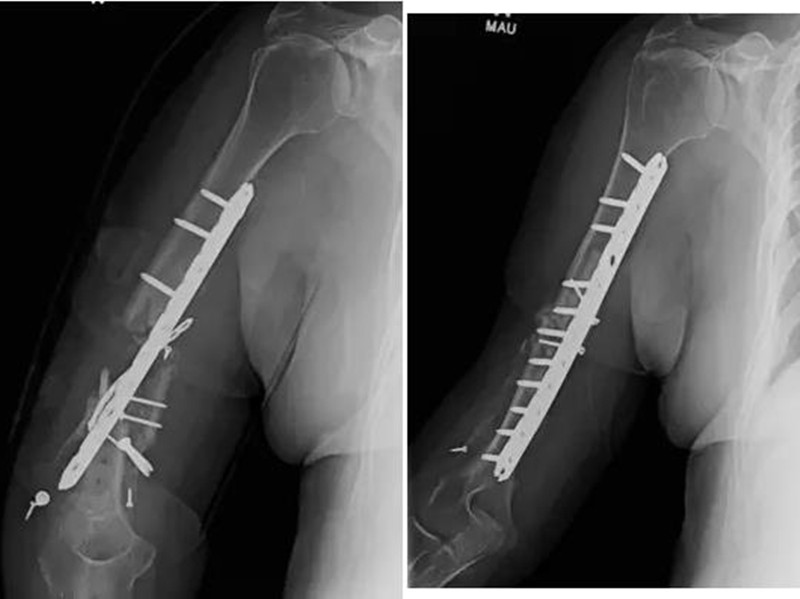 骨折三个月没有骨痂怎么办,骨折五个月没愈合是骨不连吗