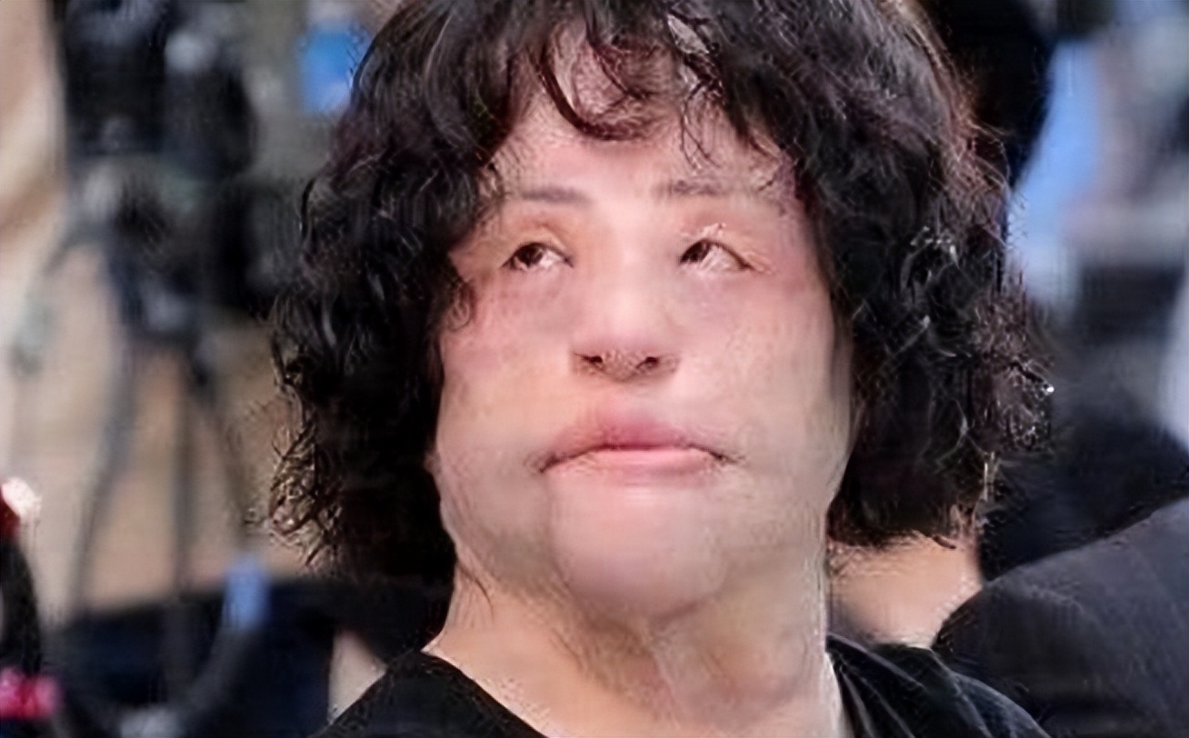 韩慧景整容是打了玻尿酸了吗,韩慧景整容案例