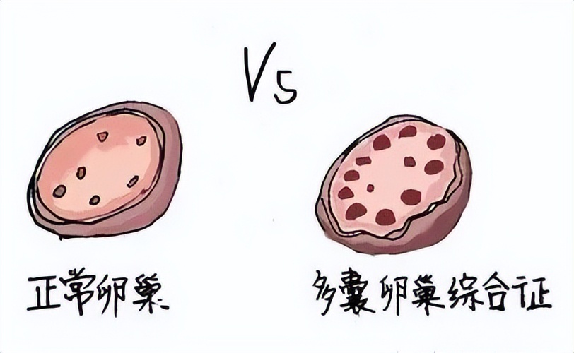 试管多囊促排卵泡长不大怎么办,多囊卵巢早衰卵泡长不大内膜薄