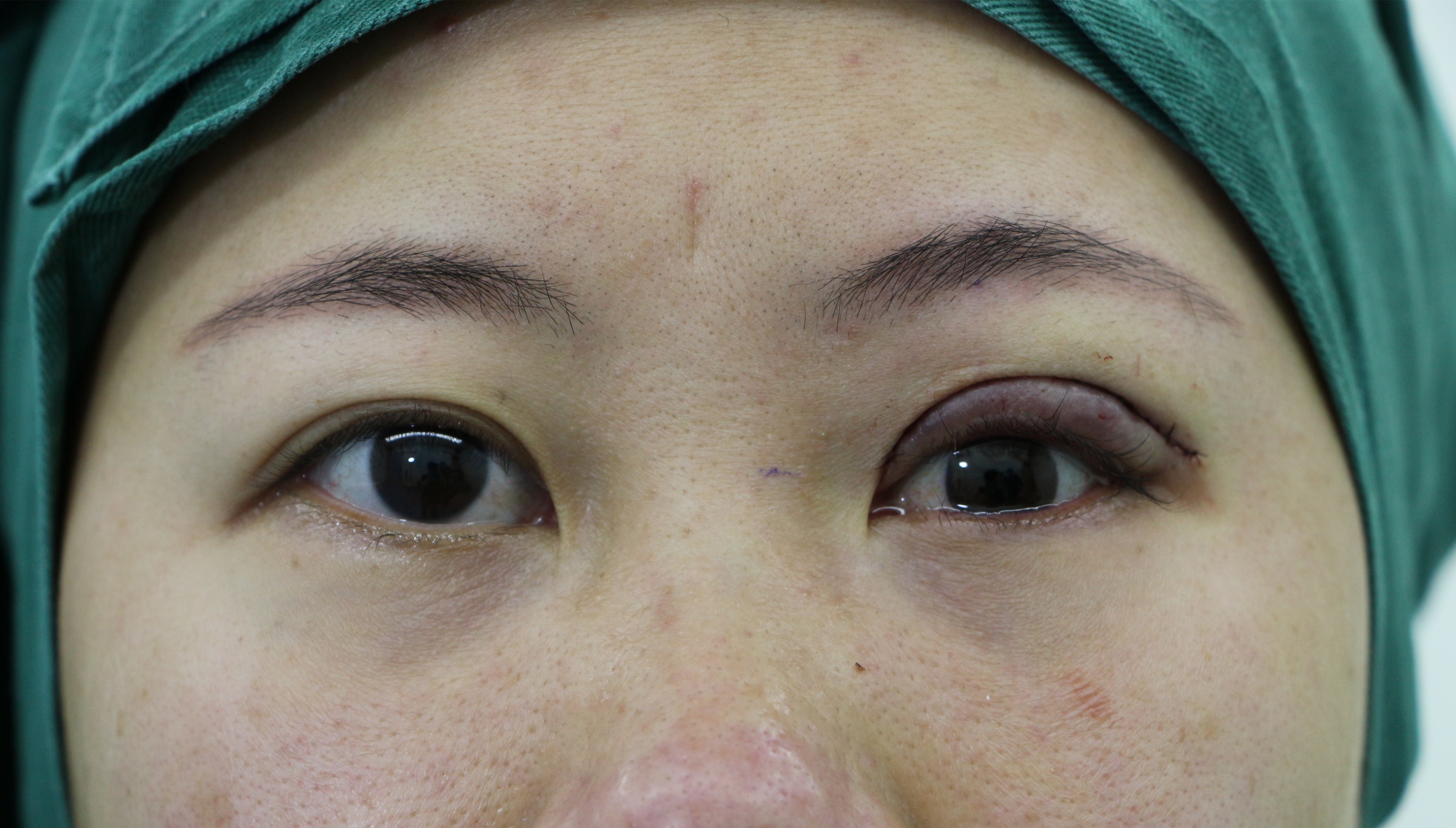 单眼上睑下垂恢复图,上眼睑下垂修复完大小眼明显