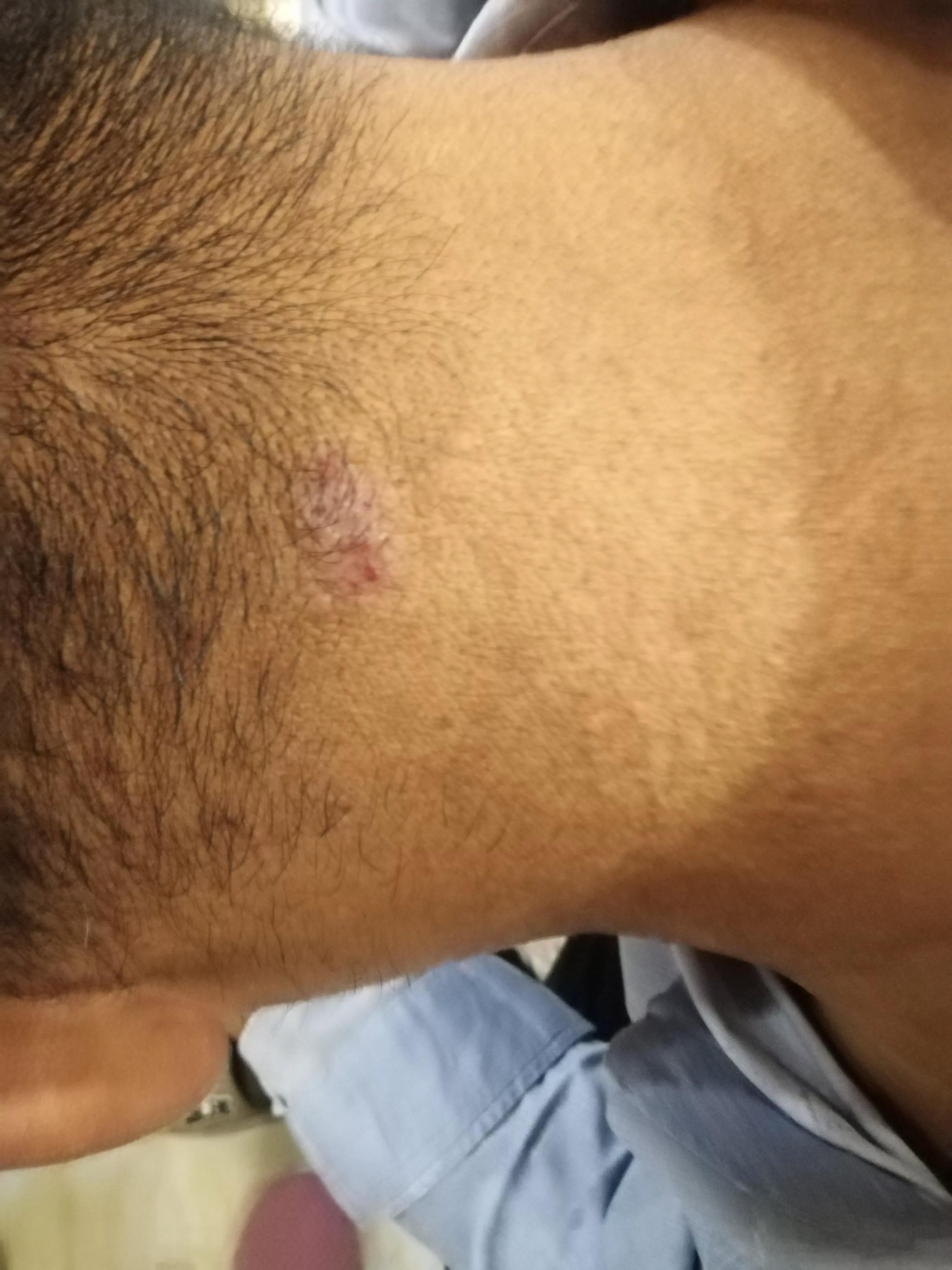 牛皮癣伴随一生是怎么样的体验,对抗牛皮癣一直在坚持