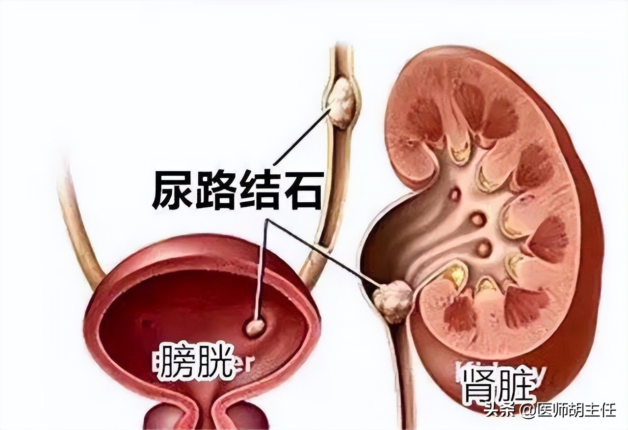 体检查出有肾结石要注意什么,体检检查出肾结石怎么处理