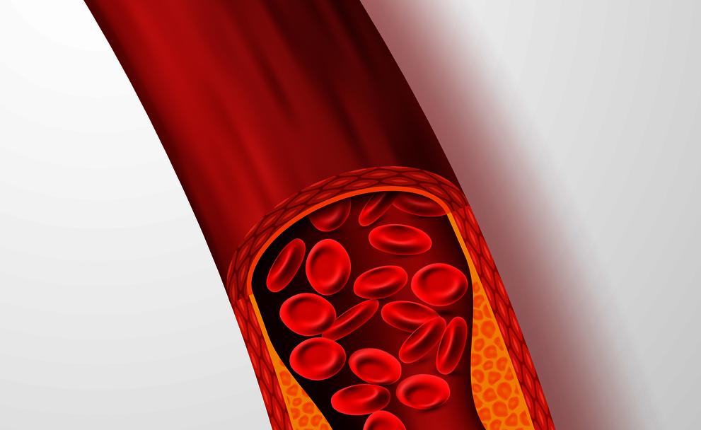 血栓最怕一味食物,心脑血栓禁忌食物