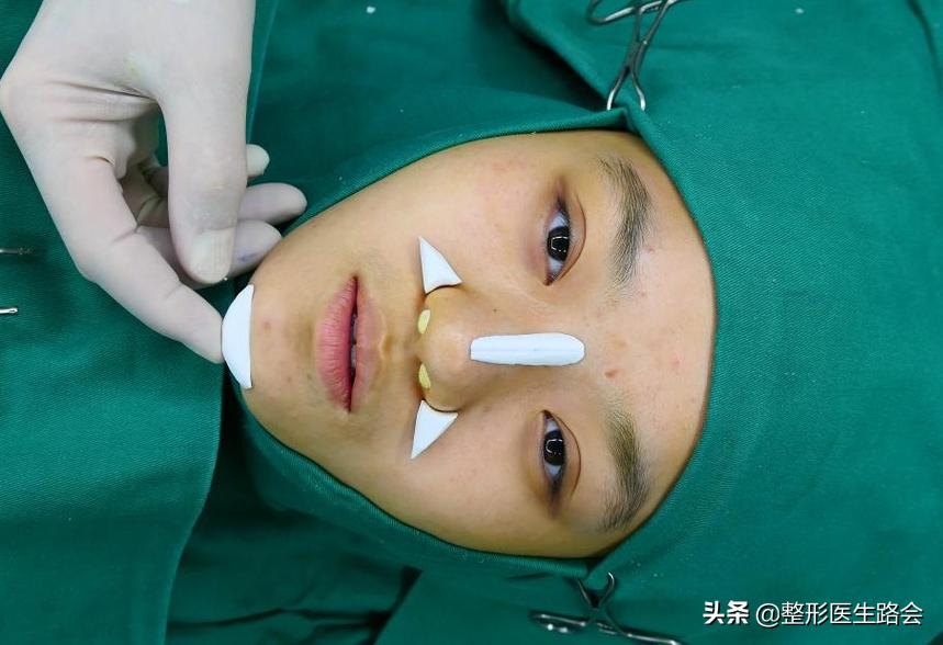 脸部整形手术成功案例,全脸整形耗时