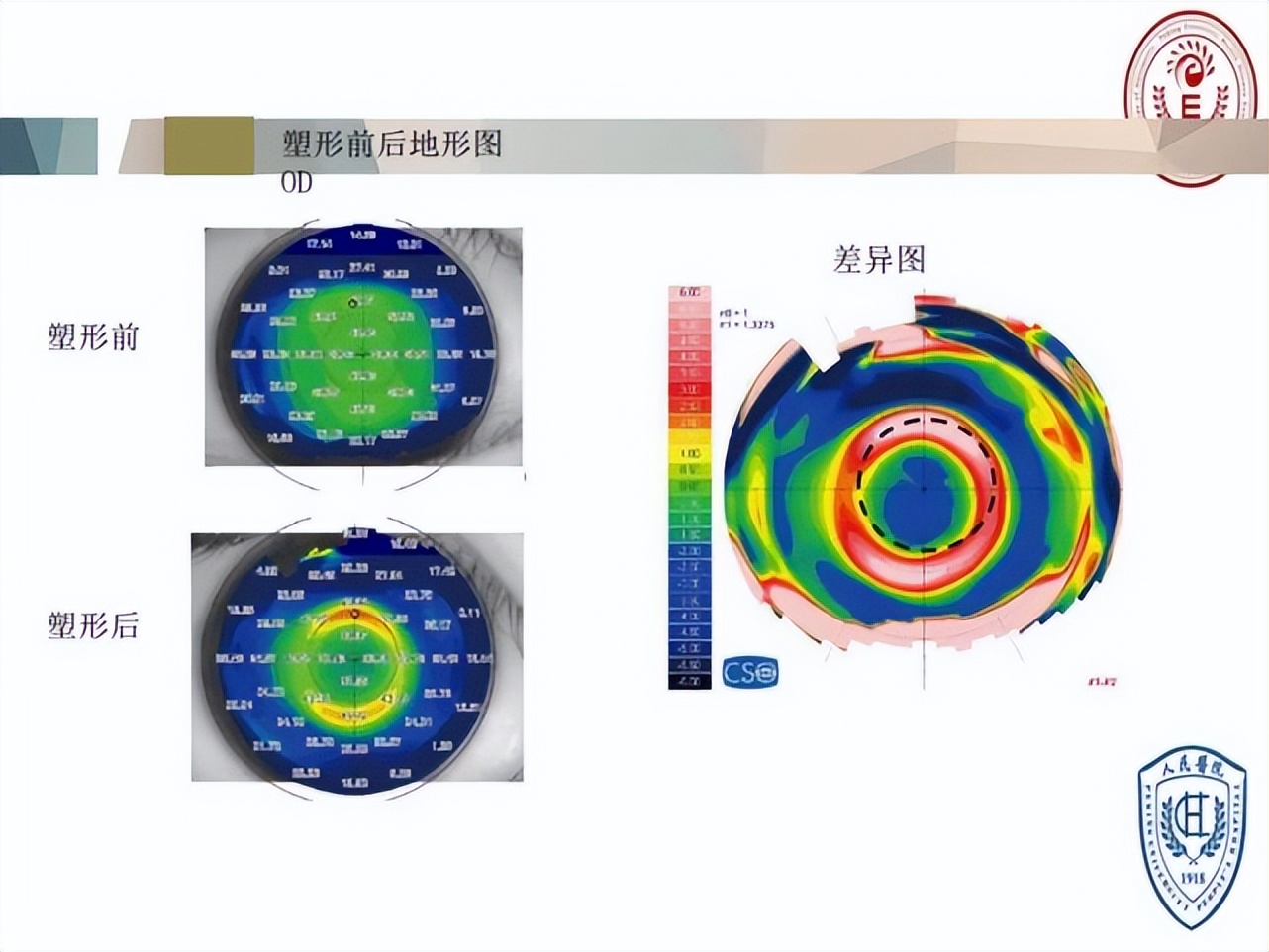 王凯角膜塑形镜原理,王凯医生塑形镜