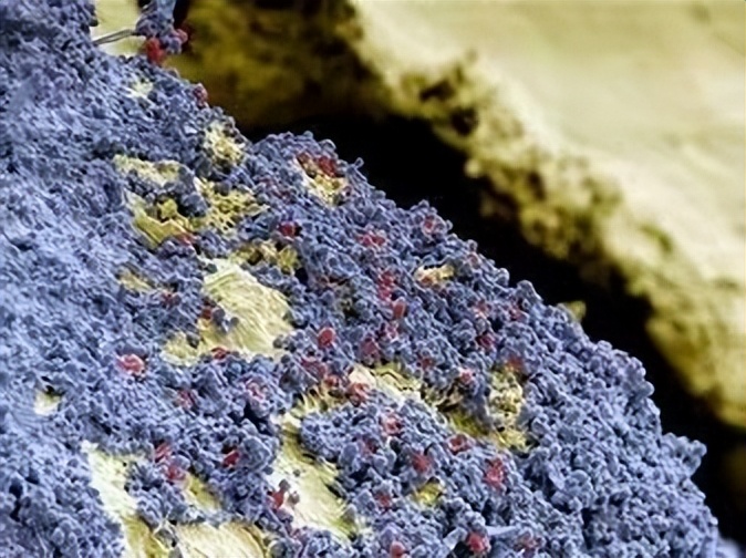 牙缝间牙结石怎样清除干净,牙缝表面的牙结石怎么洗掉