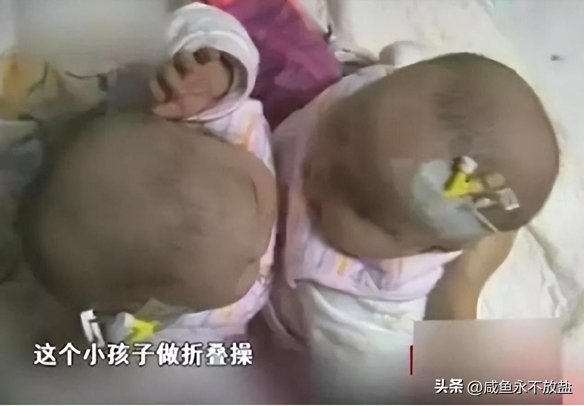 女子生下连体双胞胎后续,女子产下同母异父双胞胎完整版