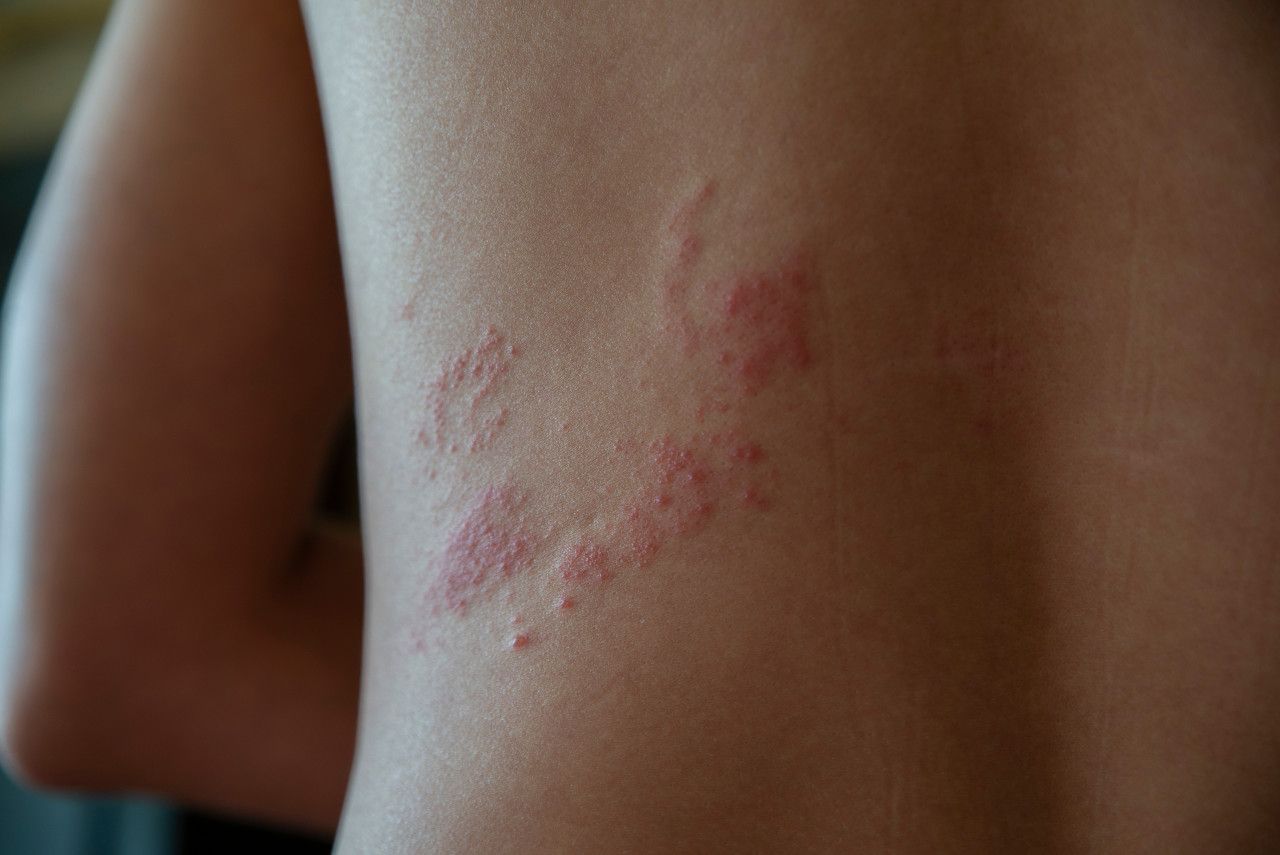 缠腰蛇带状疱疹专用药,蛇缠腰带状疱疹最佳治疗方法